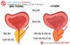 Đau tuyến tiền liệt có nên “yêu”?