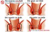 Các dạng rò hậu môn và cách điều trị hiện nay